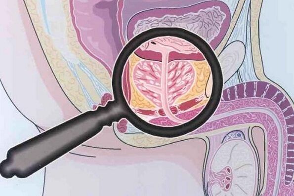 Prostatitic disease